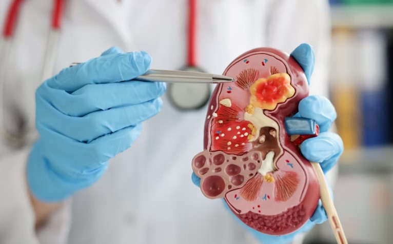 Best Hospital In USA For Kidney Stone Treatment.jpg